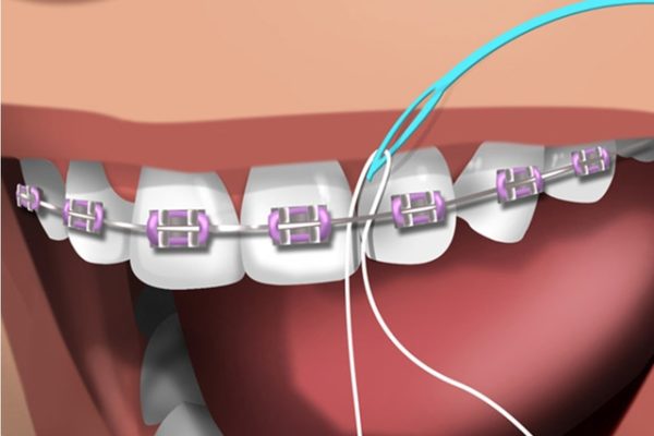 VOCÊ SABE O ESSENCIAL PARA UMA PERFEITA HIGIENIZAÇÃO EM PACIENTES QUE USAM APARELHO ORTODÔNTICO??